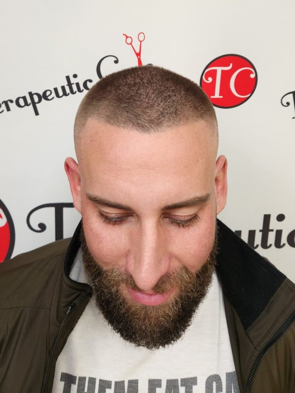 Calculating how much scalp micropigmentation costs