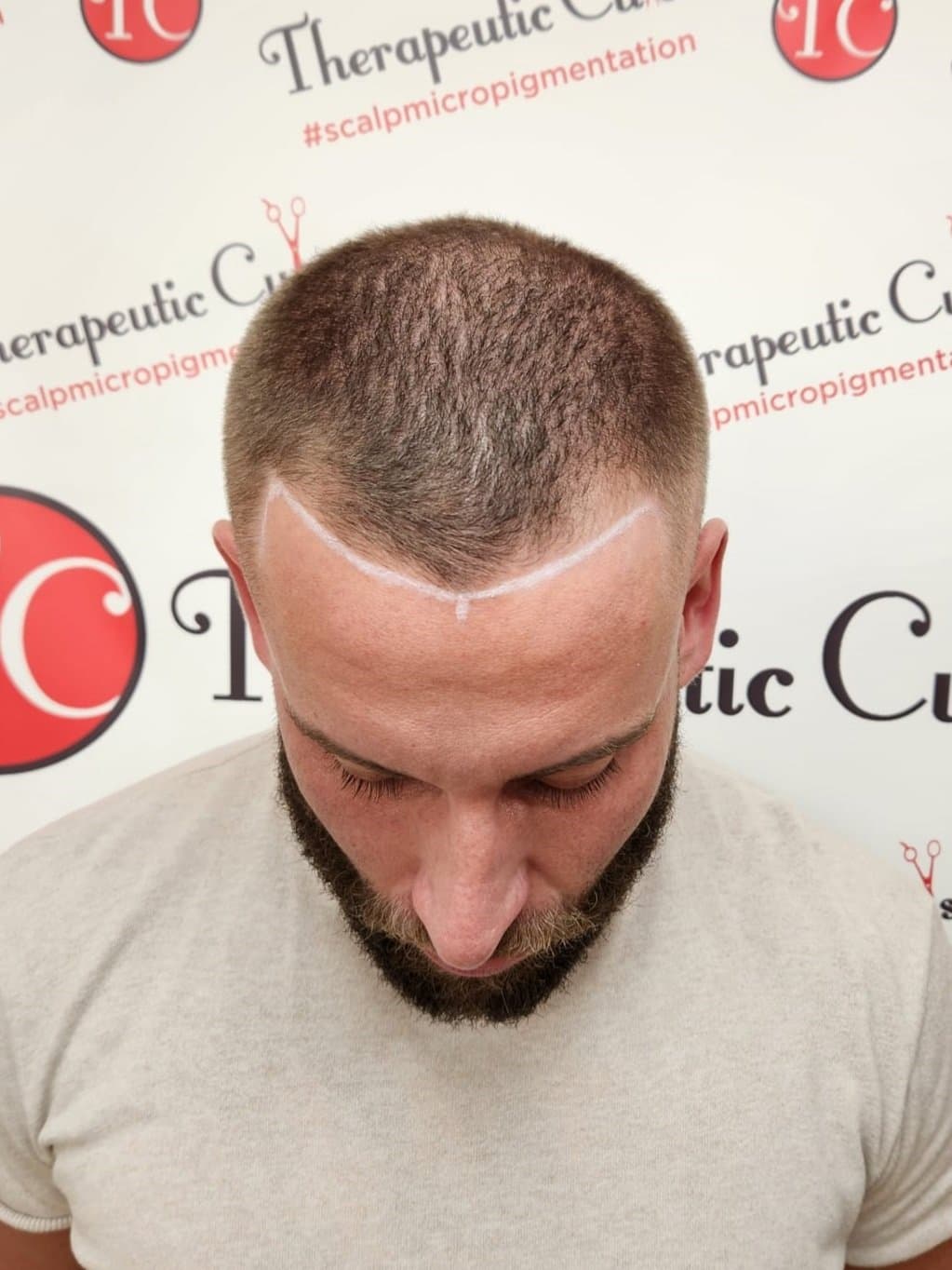 Micro scalp pigmentation treatment process showing detailed work