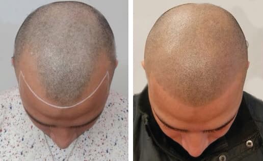 SMP scalp micropigmentation longevity and touch-up maintenance Queens NYC