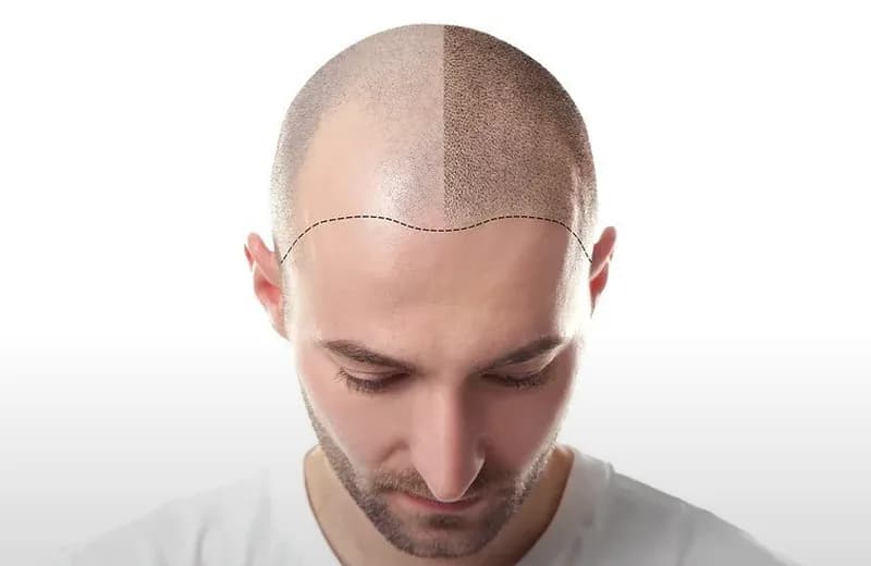 Benefits of Scalp Micropigmentation in 2026: Complete Guide — Therapeutic Cuts Benefits guide card image