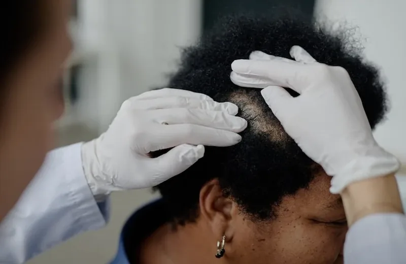 Scalp Micropigmentation Removal Cost 2026: Complete Guide — Therapeutic Cuts SMP Removal guide card image