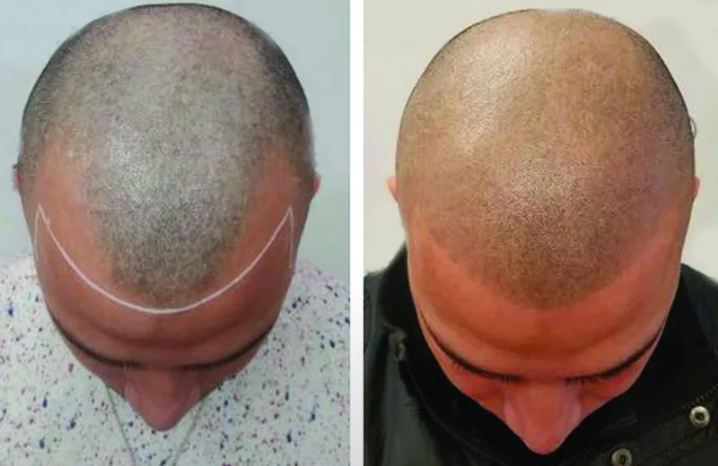SMP for Crown Thinning Queens NYC | Density Solution Guide — Therapeutic Cuts SMP Crown guide card image