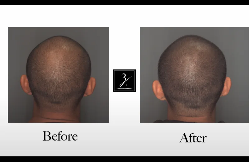 SMP vs Hair Systems & Wigs: Complete Comparison Queens NYC 2026 — Therapeutic Cuts SMP Comparison guide card image