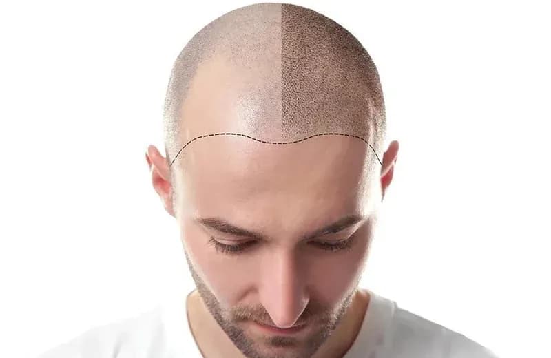 SMP hairline mapping and dot-pattern planning at Therapeutic Cuts in Queens