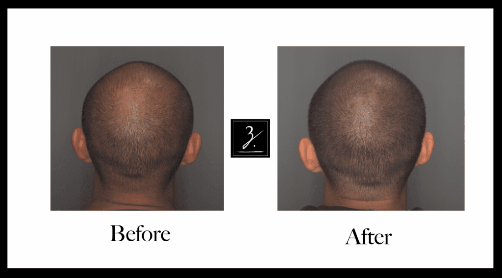 SMP scalp micropigmentation before and after results comparison showing realistic expectations Queens NYC
