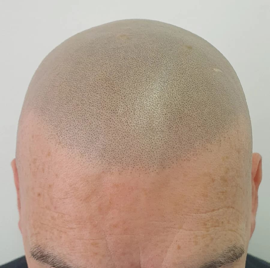 Close-up hair tattoo SMP result showing shaved follicle effect