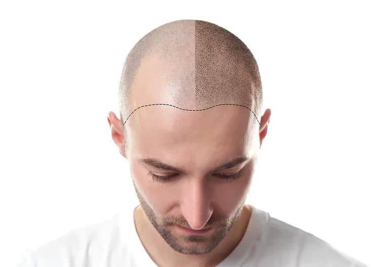 Professional scalp pigmentation treatment in NYC