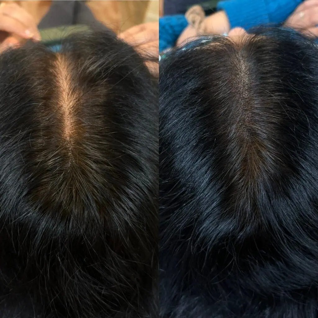 Female SMP part-line density treatment for women with thinning hair in Queens