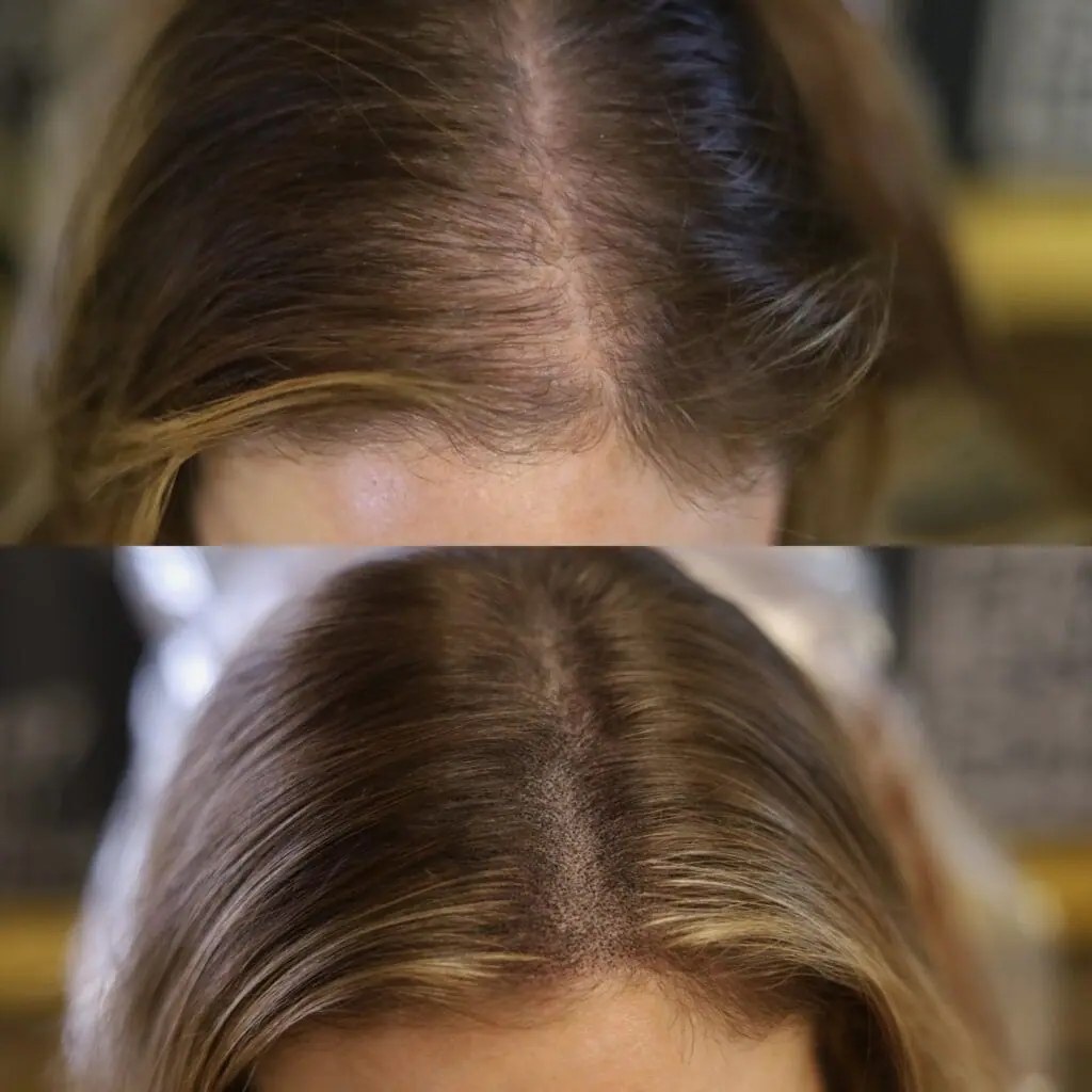 Women’s scalp micropigmentation part-line treatment example in Queens